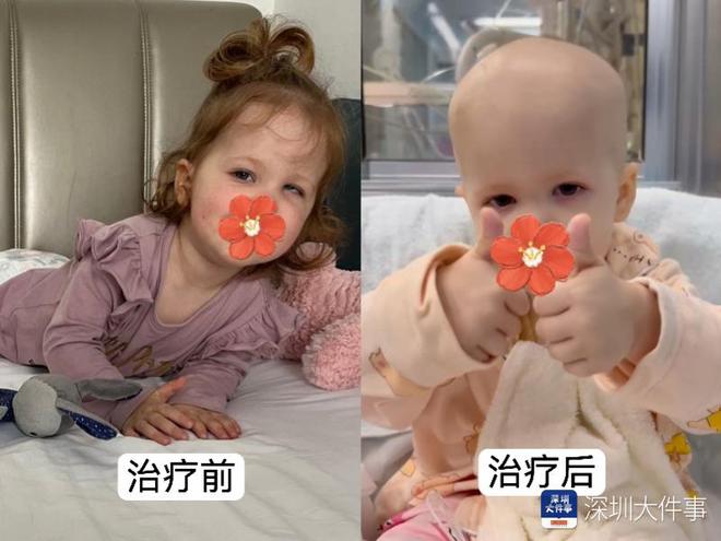基因治療“逆天改命”！瑞典罕見(jiàn)遺傳病患兒萬(wàn)里赴粵重獲新生(圖2)